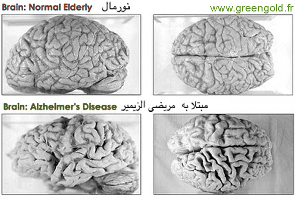 مغزمریض الزیمر