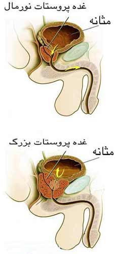 غده نورمال و غده بزرگ پروستات